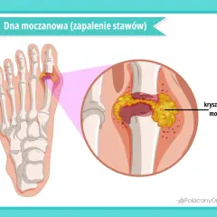 Dna moczanowa: kryształy kwasu moczowego gromadzą się w stawie palucha, powodując zapalenie.