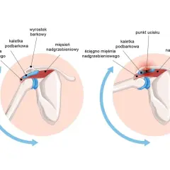 Ilustracja pokazuje staw barkowy, mięsień nadgrzebieniowy i jego ścięgno. Po prawej stronie widoczny punkt ucisku, wskazujący na problem.