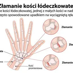 Anatomia dłoni z zaznaczoną kością łódeczkowatą i ilustracjami złamań: dalszego, trzonu i bliższego.