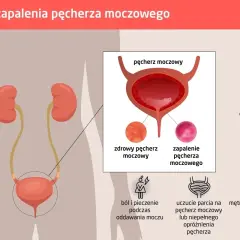 Ból i pieczenie podczas oddawania moczu to objaw zapalenia pęcherza. Grafika pokazuje układ moczowy i objawy infekcji.