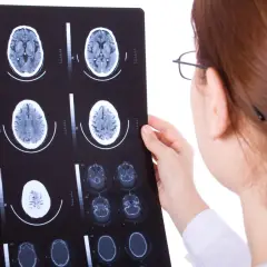 Lekarka analizuje tomografię głowy, badając przekroje mózgu na kliszy rentgenowskiej.