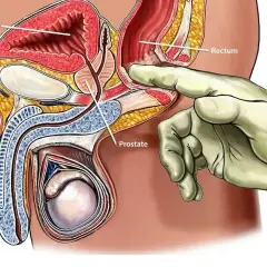 Ilustracja anatomiczna męskiego układu rozrodczego. Ręka w rękawiczce bada prostatę przez odbytnicę, co jest częścią procedury biopsji prostaty.
