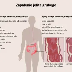 Ilustracja przedstawia objawy zapalenia jelita grubego, w tym ból brzucha, biegunki, krew w kale i osłabienie.