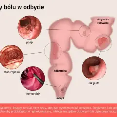 Ilustracja przedstawia przyczyny bólu w odbycie: polipy, stan zapalny, hemoroidy, raka jelita i okrężnicę esowatą.