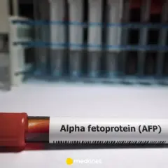 Probówka z krwią oznaczona jako "Alpha fetoprotein (AFP)". W tle stojaki z innymi próbkami.
