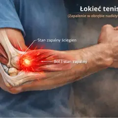 Anatomia łokcia tenisisty z zaznaczonym stanem zapalnym ścięgien i bólem.