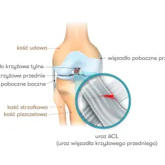 Ilustracja anatomiczna kolana z zaznaczonym zerwanym więzadłem krzyżowym przednim (ACL). Widoczne kości udowa, piszczelowa i strzałkowa.