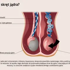 Ilustracja pokazuje skręt jądra, stanowiący przyczynę bólu jądra. Prawidłowa pozycja jądra kontra jądro po skręceniu.
