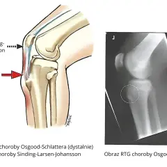 Ilustracja anatomiczna i RTG kolana pokazujące lokalizację choroby Osgooda-Schlattera, która może powodować ból nóg.