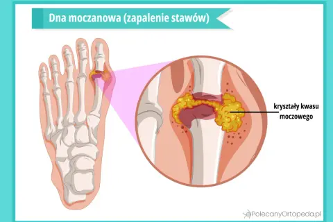 Dna moczanowa: kryształy kwasu moczowego gromadzą się w stawie palucha, powodując zapalenie.