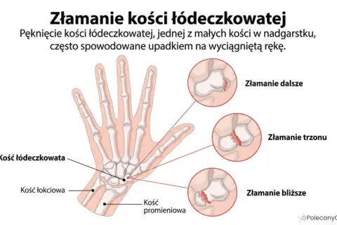 Anatomia dłoni z zaznaczoną kością łódeczkowatą i ilustracjami złamań: dalszego, trzonu i bliższego.