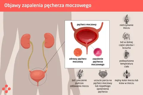Ból i pieczenie podczas oddawania moczu to objaw zapalenia pęcherza. Grafika pokazuje układ moczowy i objawy infekcji.