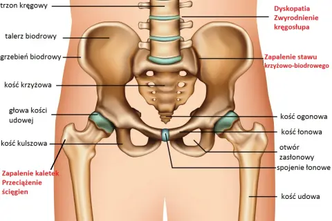Anatomia miednicy z zaznaczonymi strukturami, które mogą powodować ból stawów, np. zapalenie kaletek, przeciążenie ścięgien, zapalenie stawu krzyżowo-biodrowego.