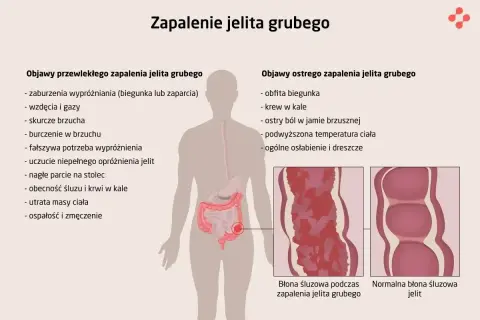 Ilustracja przedstawia objawy zapalenia jelita grubego, w tym ból brzucha, biegunki, krew w kale i osłabienie.