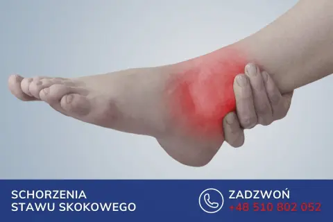 Ból w okolicy stawu skokowego, gdzie znajduje się kość strzałkowa. Czerwony obszar wskazuje na stan zapalny.