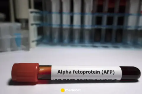 Probówka z krwią oznaczona jako "Alpha fetoprotein (AFP)". W tle stojaki z innymi próbkami.