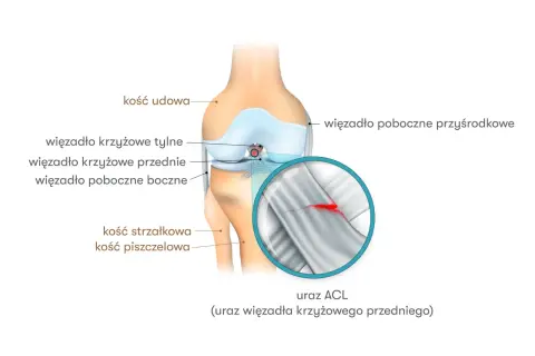 Ilustracja anatomiczna kolana z zaznaczonym zerwanym więzadłem krzyżowym przednim (ACL). Widoczne kości udowa, piszczelowa i strzałkowa.