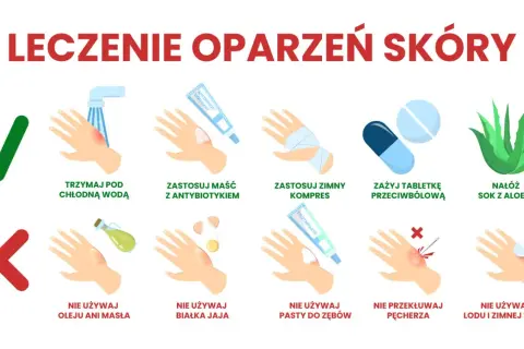 Oparzenie: Złagodź ból! Pierwsza pomoc i czego nigdy nie rób
