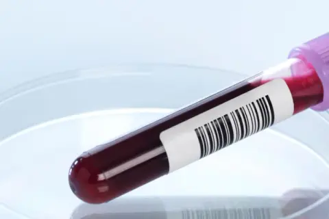 Badanie ANCA: Co to jest? Zrozum wyniki i choroby autoimmunologiczne.