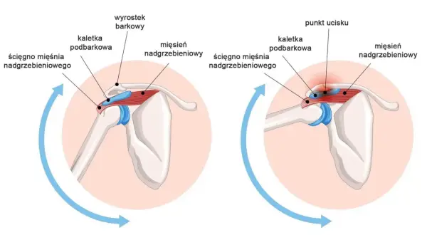 Ilustracja pokazuje staw barkowy, mięsień nadgrzebieniowy i jego ścięgno. Po prawej stronie widoczny punkt ucisku, wskazujący na problem.