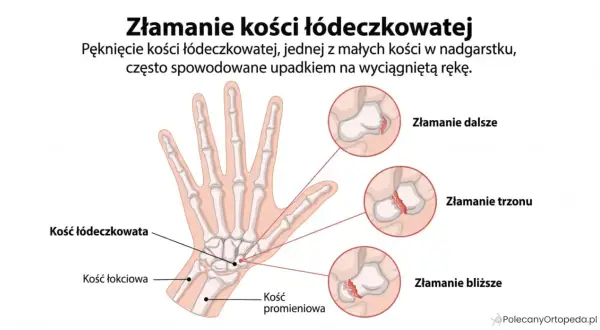 Anatomia dłoni z zaznaczoną kością łódeczkowatą i ilustracjami złamań: dalszego, trzonu i bliższego.