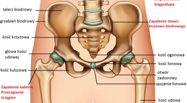 Anatomia miednicy z zaznaczonymi strukturami, które mogą powodować ból stawów, np. zapalenie kaletek, przeciążenie ścięgien, zapalenie stawu krzyżowo-biodrowego.