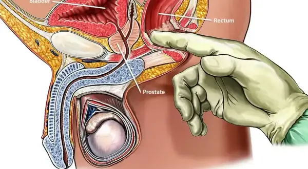 Ilustracja anatomiczna męskiego układu rozrodczego. Ręka w rękawiczce bada prostatę przez odbytnicę, co jest częścią procedury biopsji prostaty.