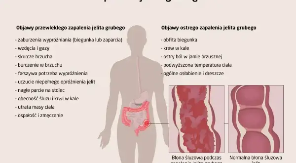 Ilustracja przedstawia objawy zapalenia jelita grubego, w tym ból brzucha, biegunki, krew w kale i osłabienie.