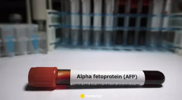 Probówka z krwią oznaczona jako "Alpha fetoprotein (AFP)". W tle stojaki z innymi próbkami.