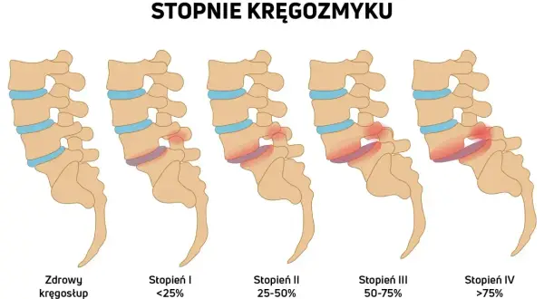 Ilustracja pokazuje stopnie kręgozmyku od zdrowego kręgosłupa do zaawansowanego, gdzie kręgi przesuwają się względem siebie.