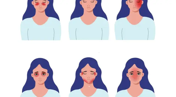 Ilustracje przedstawiają kobiety z różnymi lokalizacjami bólu głowy, w tym z bólem głowy z lewej strony.