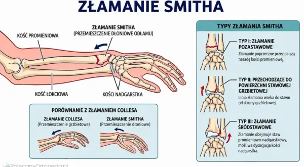 Złamanie Smitha to uraz kości promieniowej z przemieszczeniem odłamu w kierunku dłoniowym. Ilustracja pokazuje typy złamania i porównanie z złamaniem Collesa.