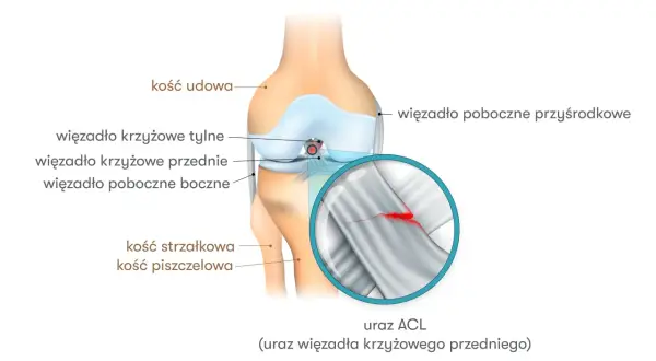 Ilustracja anatomiczna kolana z zaznaczonym zerwanym więzadłem krzyżowym przednim (ACL). Widoczne kości udowa, piszczelowa i strzałkowa.