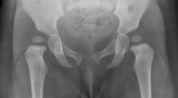RTG miednicy z widoczną dysplazją stawu biodrowego, gdzie główki kości udowych nie są prawidłowo osadzone w panewkach.