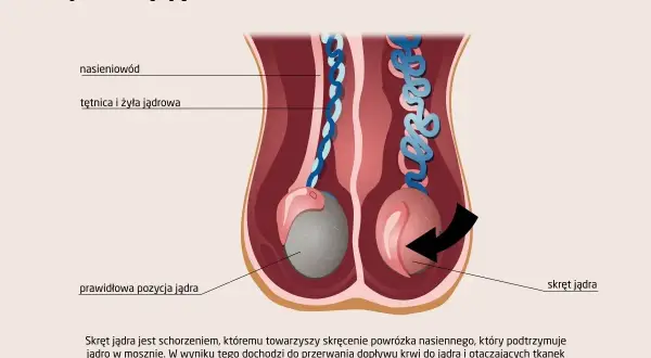 Ilustracja pokazuje skręt jądra, stanowiący przyczynę bólu jądra. Prawidłowa pozycja jądra kontra jądro po skręceniu.