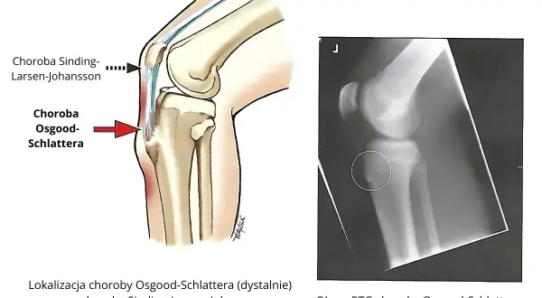 Ilustracja anatomiczna i RTG kolana pokazujące lokalizację choroby Osgooda-Schlattera, która może powodować ból nóg.