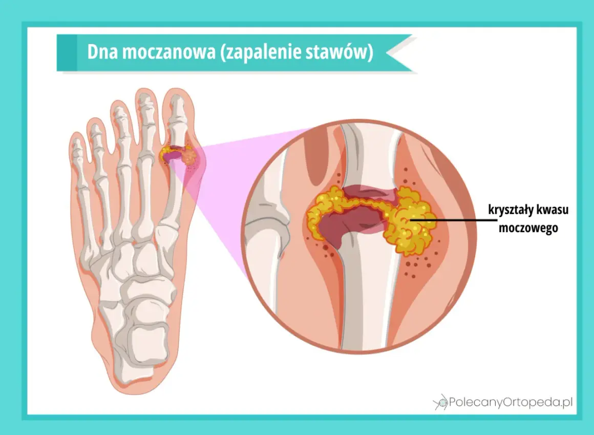 Dna moczanowa: kryształy kwasu moczowego gromadzą się w stawie palucha, powodując zapalenie.