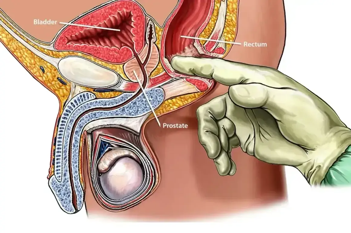 Ilustracja anatomiczna męskiego układu rozrodczego. Ręka w rękawiczce bada prostatę przez odbytnicę, co jest częścią procedury biopsji prostaty.