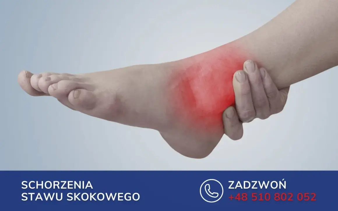 Ból w okolicy stawu skokowego, gdzie znajduje się kość strzałkowa. Czerwony obszar wskazuje na stan zapalny.