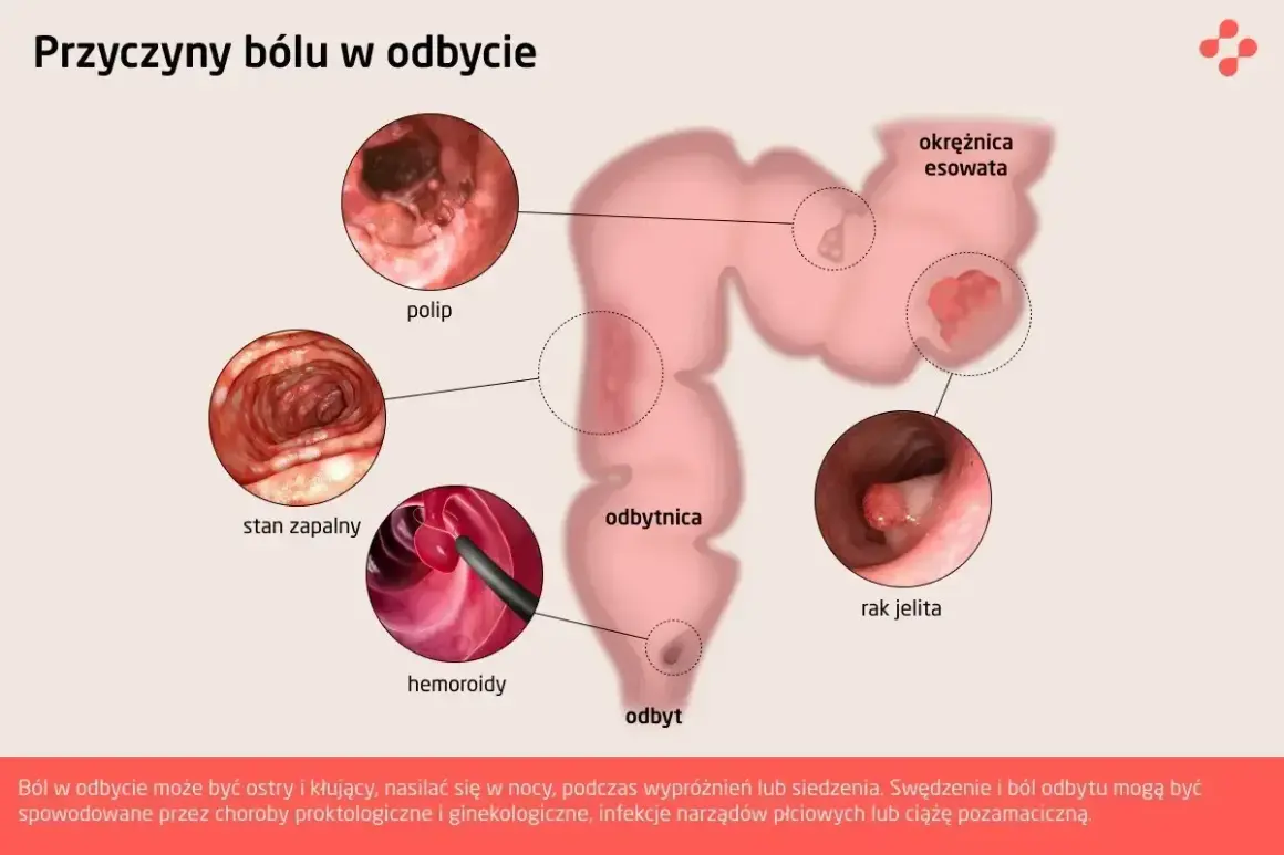 Ilustracja przedstawia przyczyny bólu w odbycie: polipy, stan zapalny, hemoroidy, raka jelita i okrężnicę esowatą.