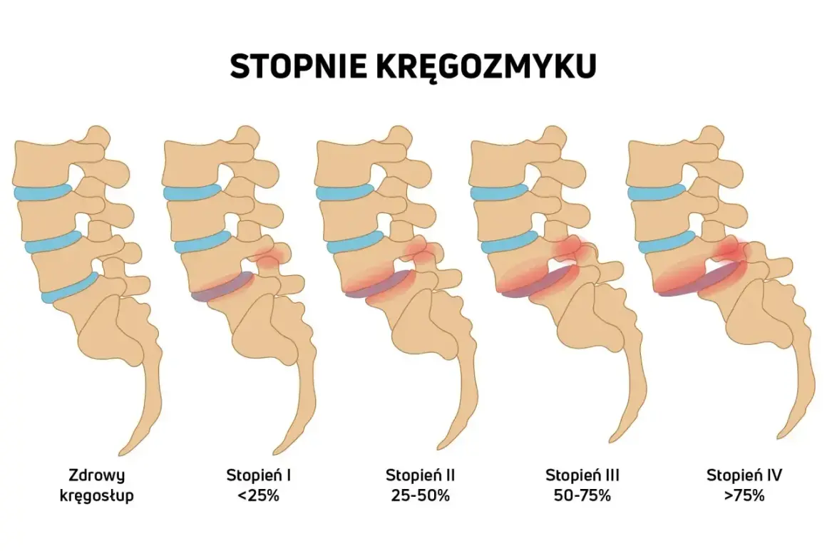 Ilustracja pokazuje stopnie kręgozmyku od zdrowego kręgosłupa do zaawansowanego, gdzie kręgi przesuwają się względem siebie.