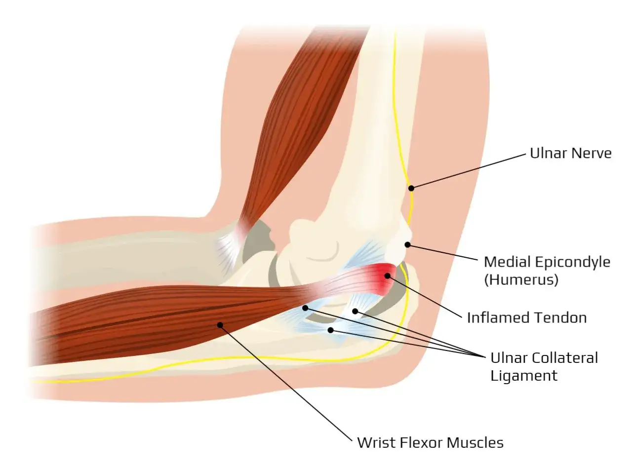 Anatomia łokcia z zapaleniem ścięgna, objawem łokcia golfisty. Widoczny nerw łokciowy, więzadło poboczne łokciowe i mięśnie zginacze nadgarstka.