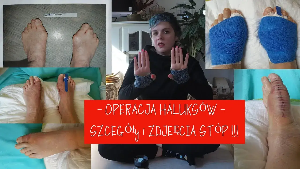 porównanie kosztów operacji haluksów NFZ prywatnie