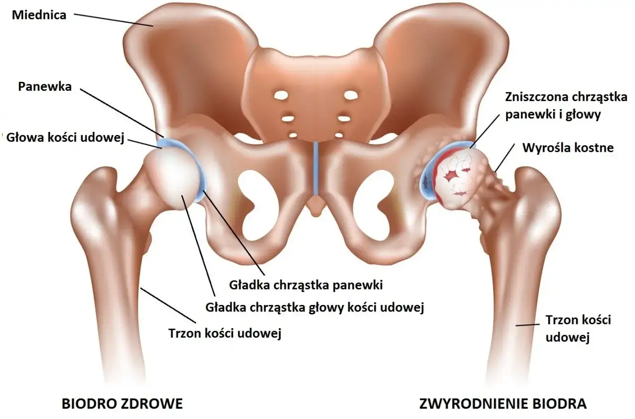 Porównanie zdrowego biodra z biodrem ze zwyrodnieniem, gdzie widać zniszczoną chrząstkę i wyrośla kostne, co może powodować ból biodra.
