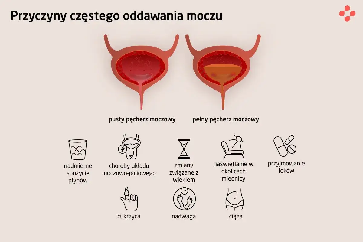 Ilustracja pokazuje przyczyny częstego oddawania moczu, w tym choroby układu moczowo-płciowego, które mogą powodować ból przy oddawaniu moczu.