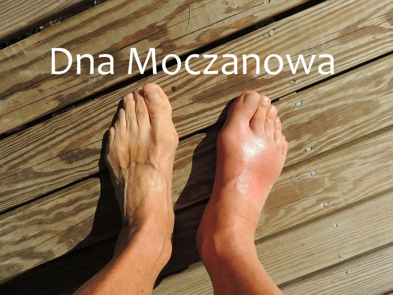 Dwa stopy na drewnianym tarasie. Lewa stopa wygląda normalnie, prawa jest zaczerwieniona i opuchnięta, co sugeruje podagrę.