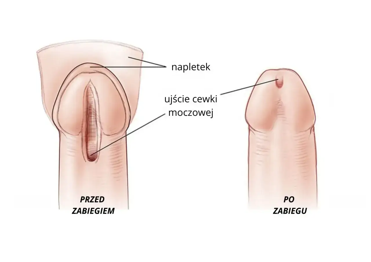 Porównanie wymazu z cewki moczowej i uretroskopii, narzędzia diagnostyczne urologia