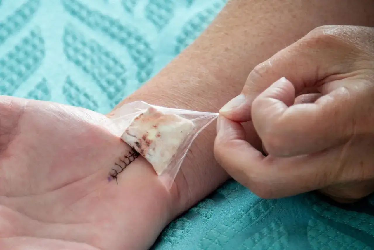 rehabilitacja dłoni po operacji cieśni nadgarstka