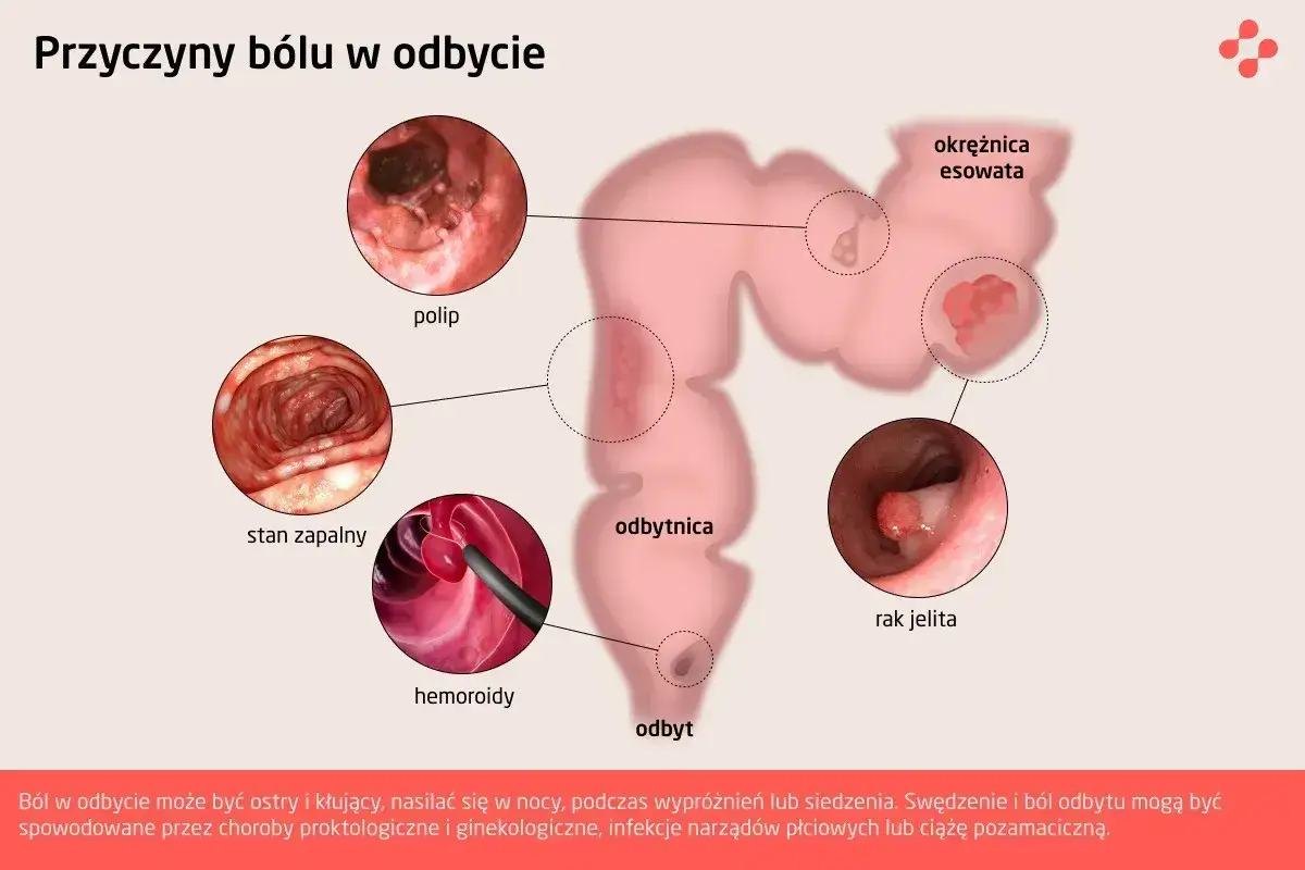 Ilustracja przedstawia przyczyny bólu w odbycie: polipy, stan zapalny, hemoroidy, raka jelita i okrężnicę esowatą.