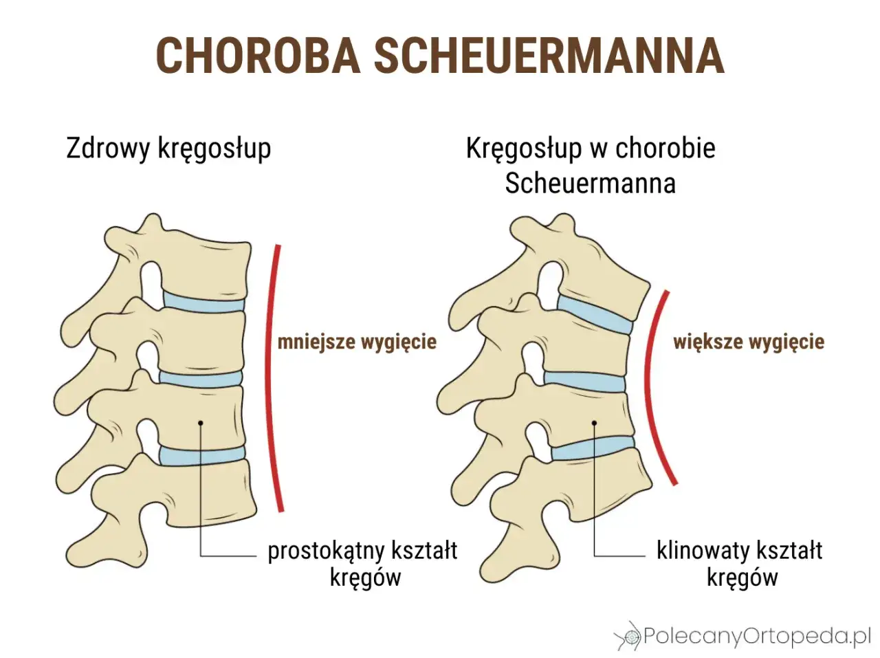 Porównanie zdrowego kręgosłupa z kręgosłupem w chorobie Scheuermanna, gdzie występuje większe wygięcie i klinowaty kształt kręgów, czyli kifoza.